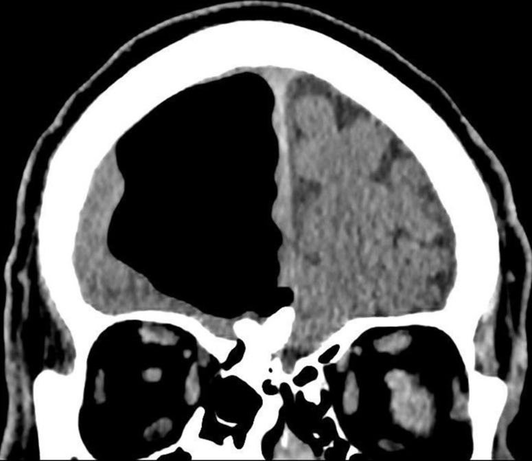 Tomografia mostra o bolso de ar e o tumor do paciente (Foto: BMJ Case Reports)