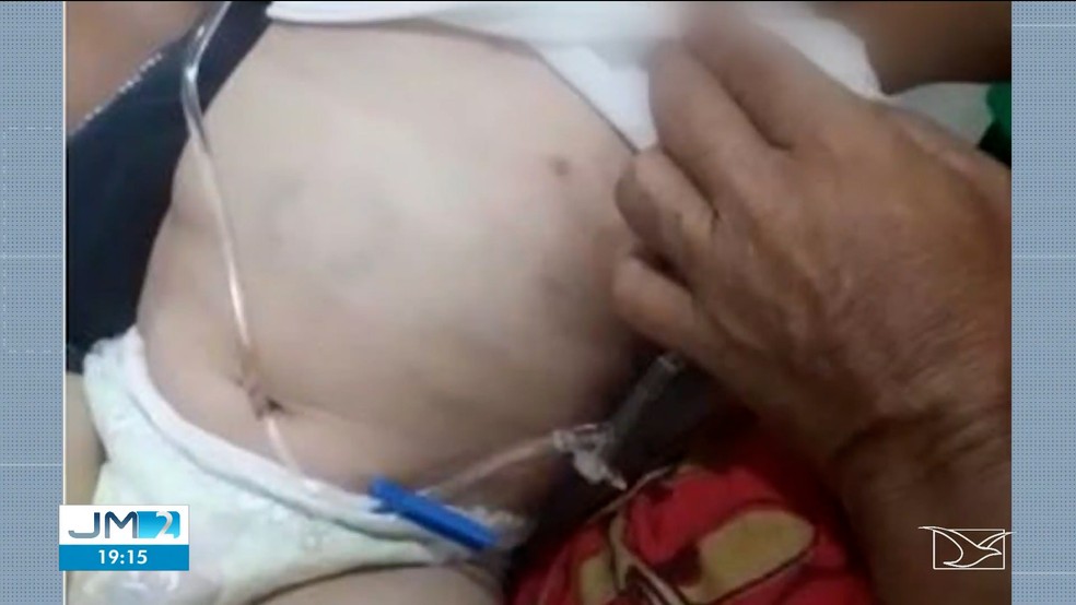 Polícia investiga caso de bebê internado com marcas de mordidas e costelas quebradas em São Luís; pais estão presos suspeitos de maus-tratos — Foto: Reprodução/TV Mirante