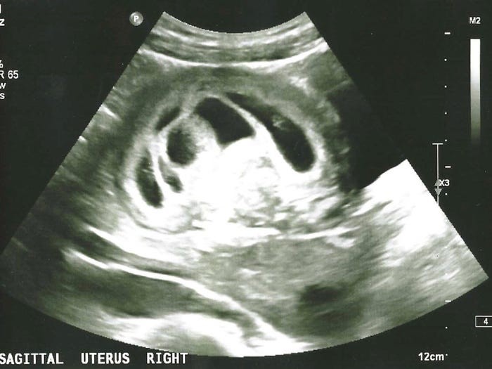 Ultrassom  mostrando seis fetos (Foto: Reprodução/Insider)