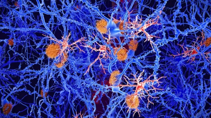 Os cientistas identificaram o beta-amilóide (mostrado em laranja) como tendo efeitos nocivos na doença de Alzheimer (Foto: GETTY IMAGES via BBC)