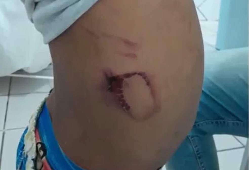 Criança de quatro anos tinha hematomas pelo corpo — Foto: TV Santa Cruz