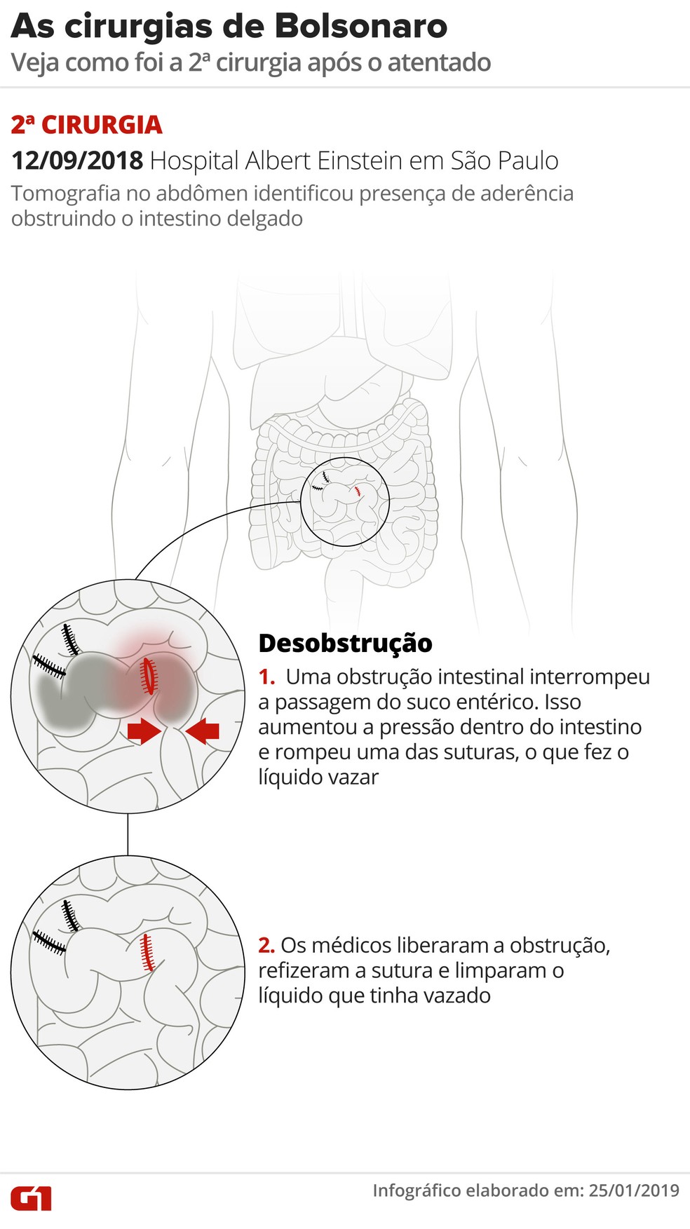 Arte mostra como foi a segunda cirurgia de Jair Bolsonaro — Foto: Alexandre Mauro/G1