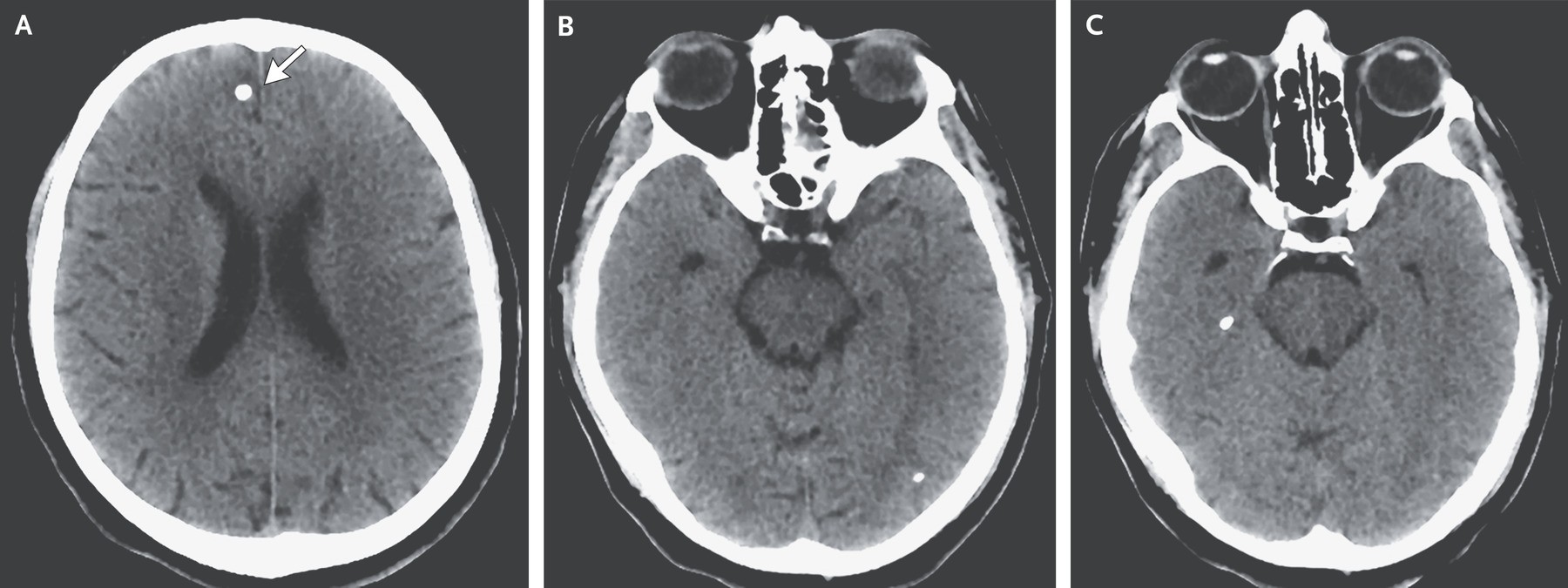 Tomografia computadorizada da cabeça do paciente  (Foto: Copyright © 2021, Massachusetts Medical Society)