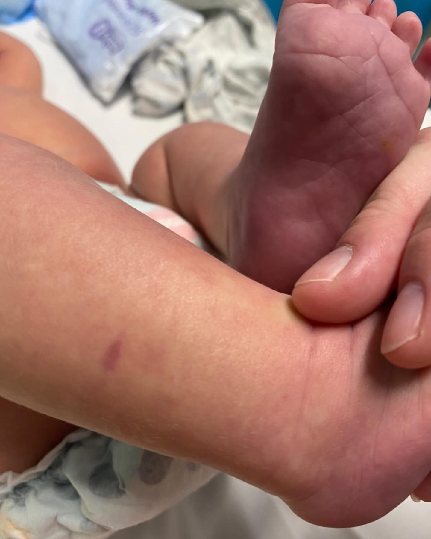 A manchinha na pele do pequeno Lachlan: você saberia que isso poderia ser sinal de uma doença grave? (Foto: Reprodução/ Instagram)