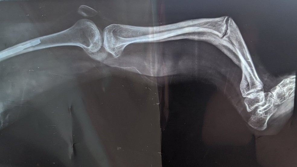 Beatriz sofreu diversas dores e fraturas ao longo da vida, certa vez, caiu sentada e quebrou a perna em forma de S — Foto: Arquivo Pessoal