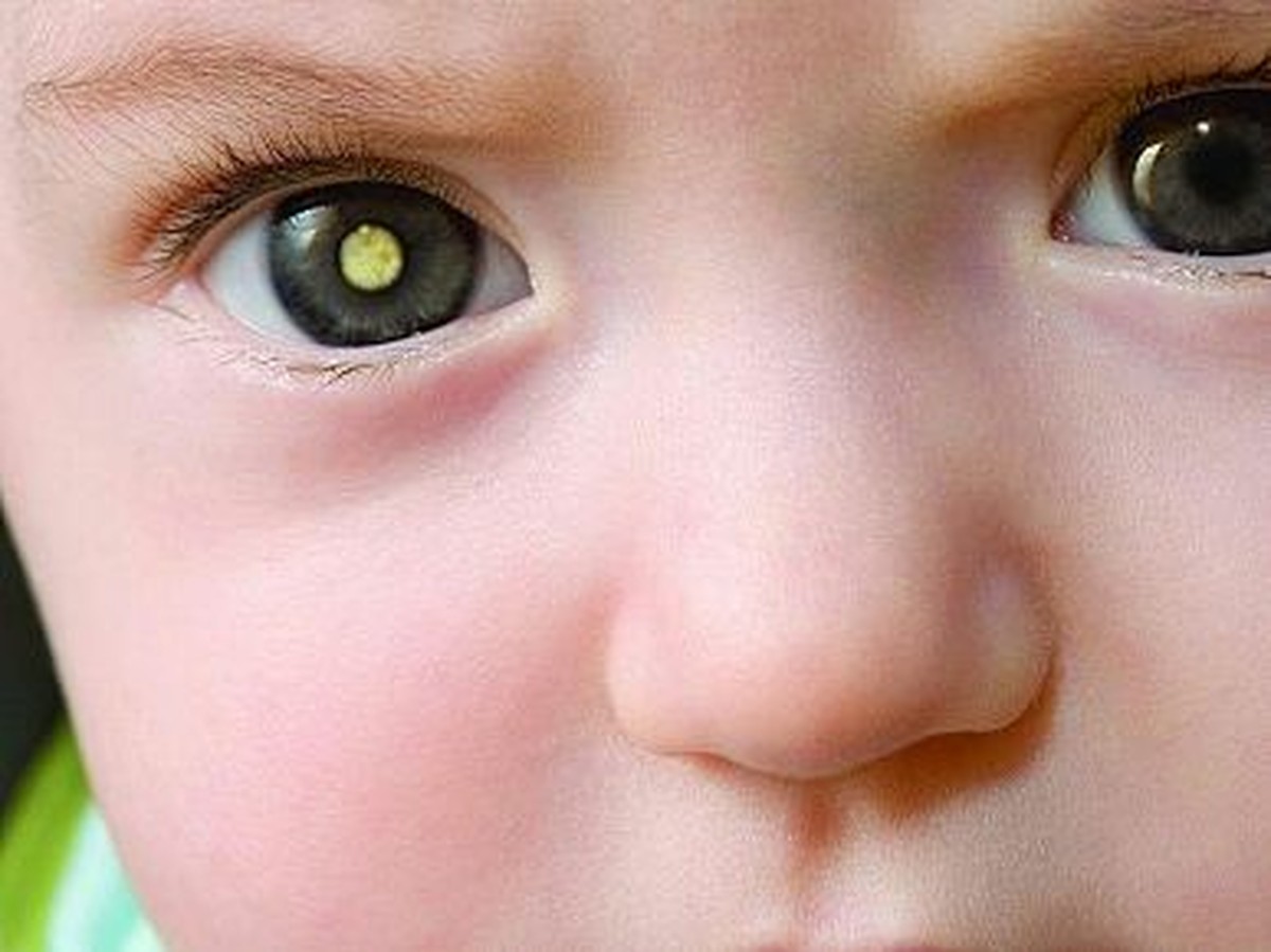 Retinoblastoma diagnóstico precoce é a chave para o sucesso do