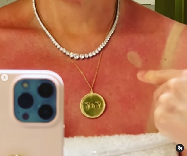 Thalia exagera no sol e mostra corpo vermelho (Foto: Reprodução/Instagram)