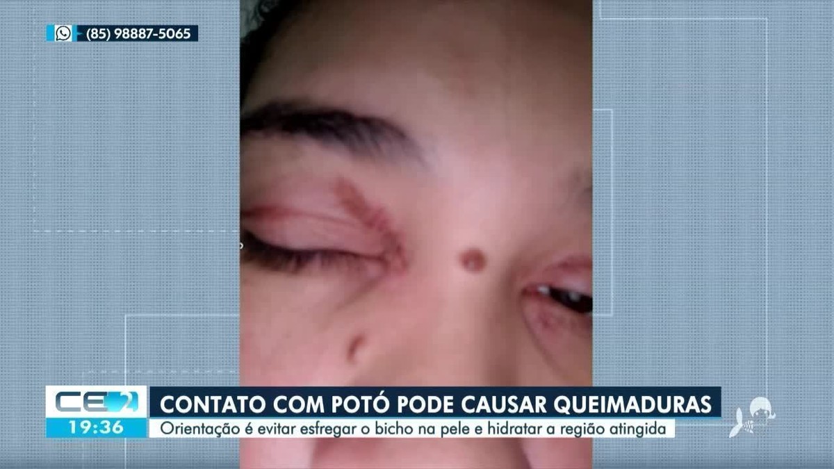 Besouro potó contato pode causar queimaduras de até 2º grau na pele; conheça cuidados e