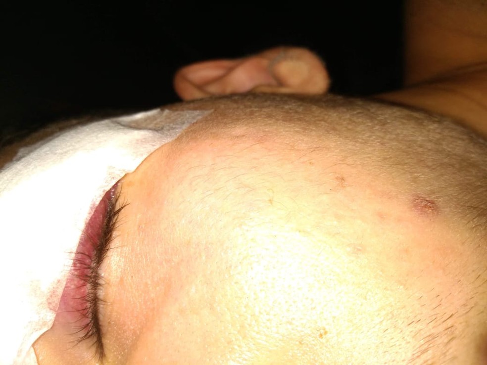 Após fratura no supercílio esquerdo, ele passou por procedimento de cirurgia plástica e segue em recuperação — Foto: G1 Santos