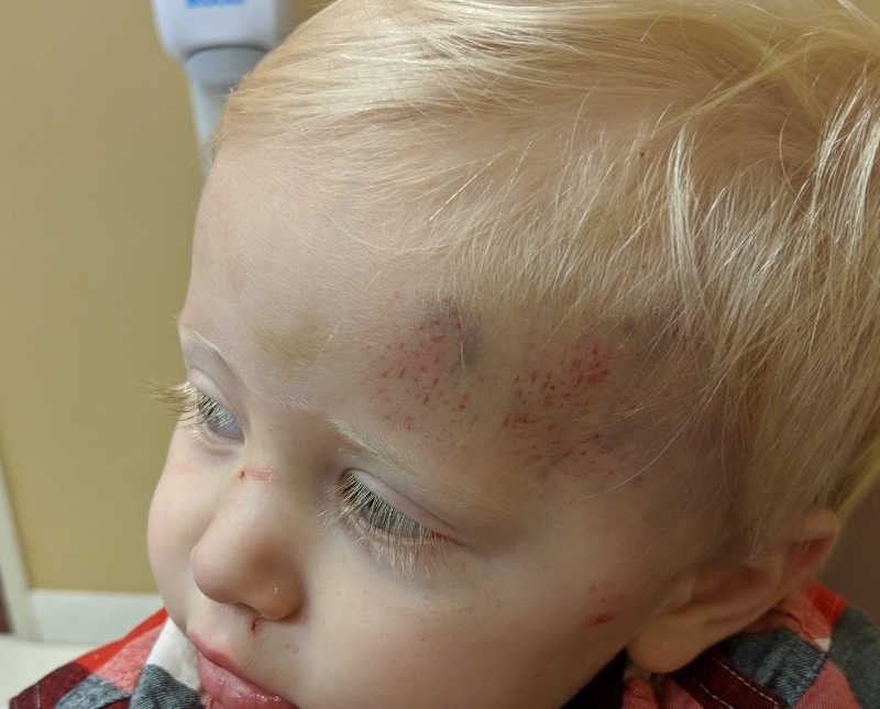 Médicos identificaram que os hematomas de Luke eram condizentes a abuso físico e não a uma queda (Foto: Arquivo pessoal)