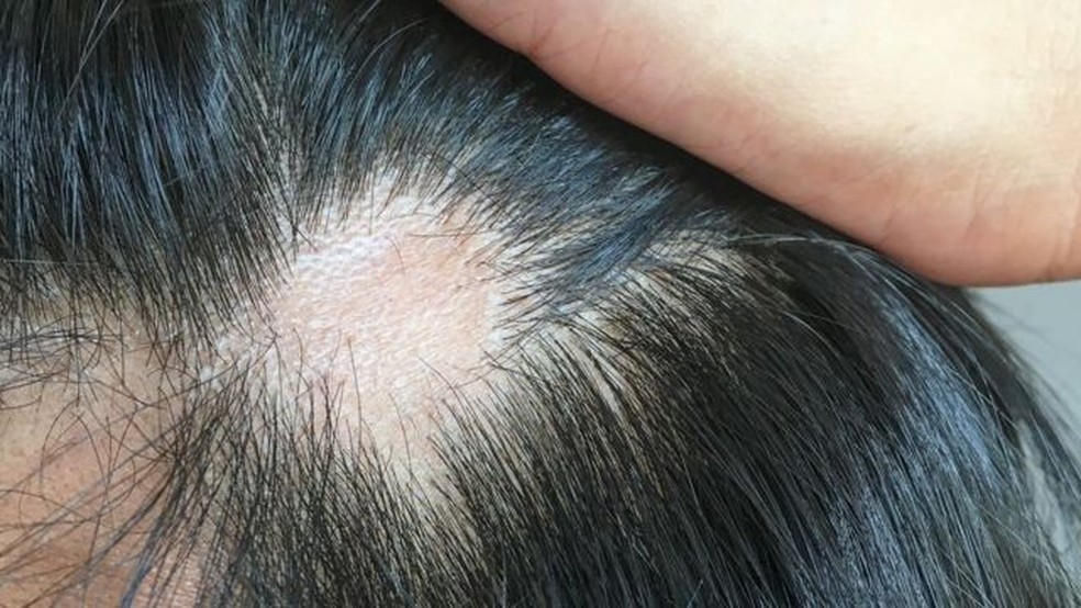 Queda de cabelo é um dos efeitos possíveis trazidos pela COVID-19. — Foto: iStock