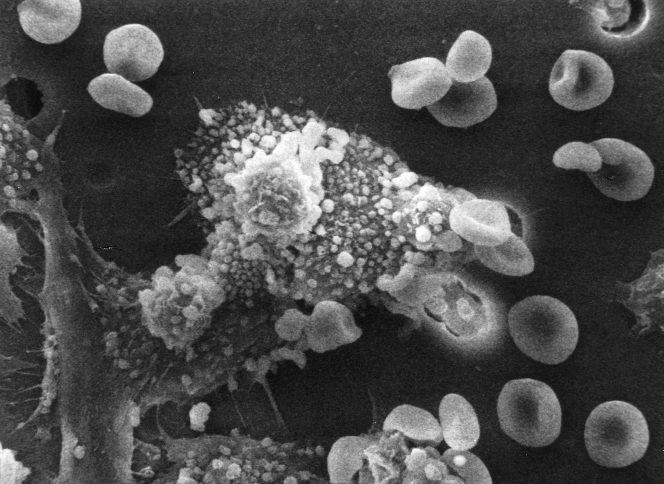 Macrófagos ao redor de uma célula cancerígena (Foto: wikimedia commons)