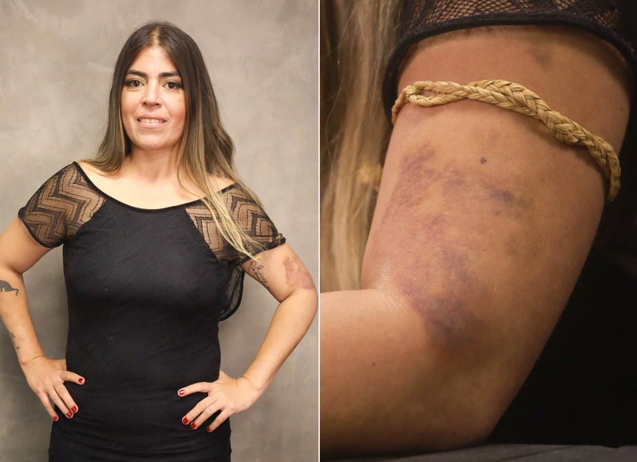 Bruna Surfistinha acusa ex-marido de agressão e mostra hematomas