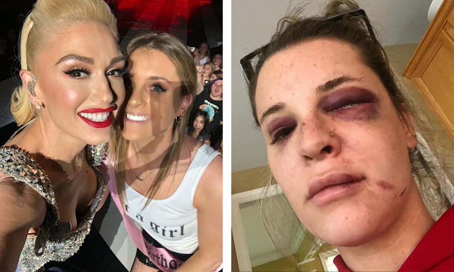 Gwen Stefani reage a fã que a creditou por ter sobrevivido após ser jogada em trilho de metrô (à direita, foto de Maddie com ferimentos no rosto após ser atacada por homem no metrô de Nova York