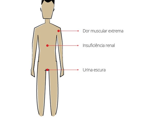 Infográfico Mialgia (Foto: Infográfico G1)