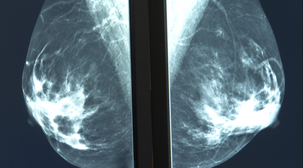 Exame de mamografia é essencial na prevenção do câncer de mama — Foto: Sérgio Oliveira/EPTV