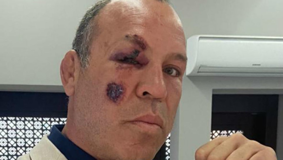 Wanderlei Silva postou o rosto ferido após ser atropelado ao andar de bicicleta em Curitiba — Foto: Arquivo pessoal