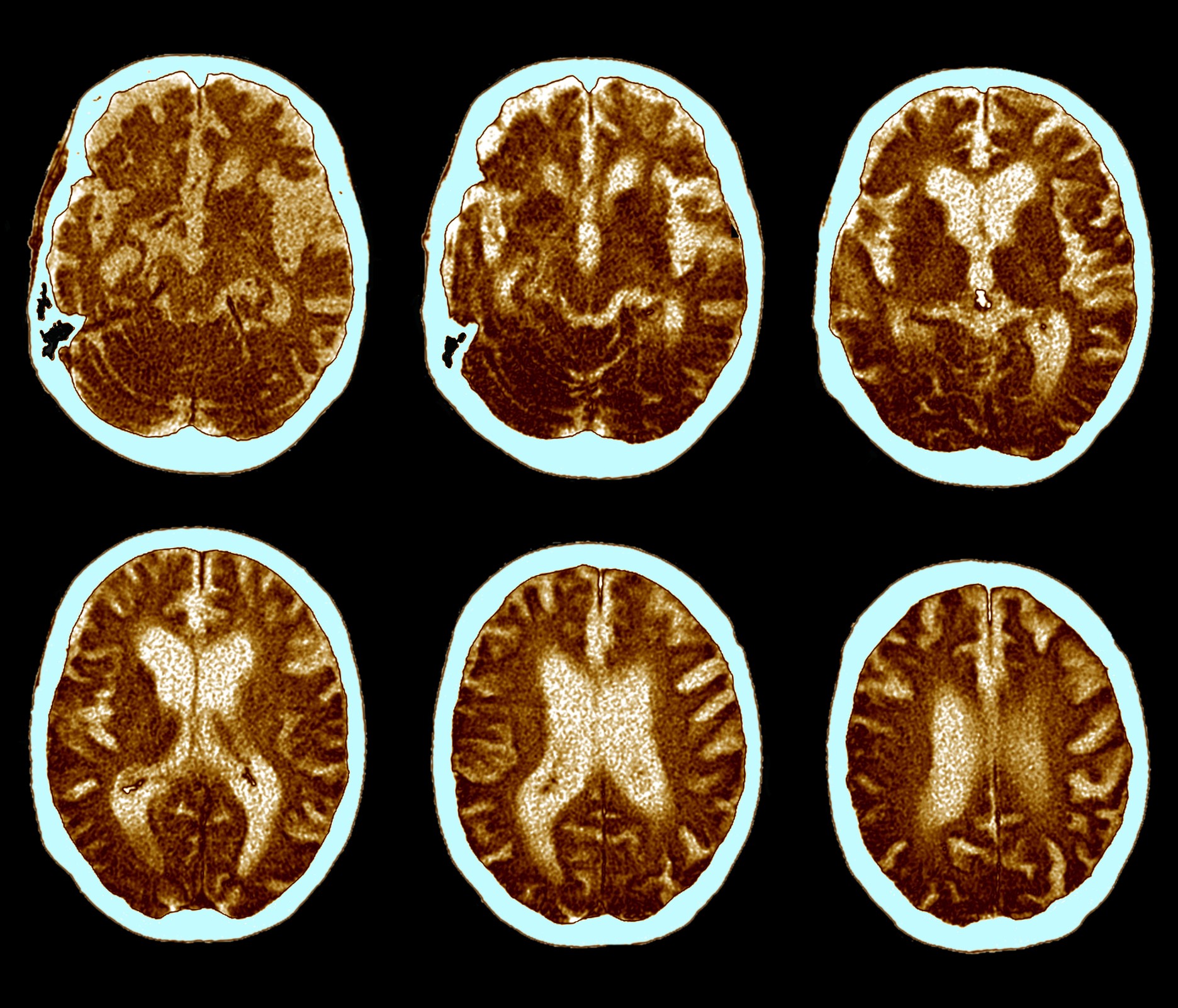 cientistas-avan-am-na-cria-o-de-um-exame-de-sangue-para-o-alzheimer