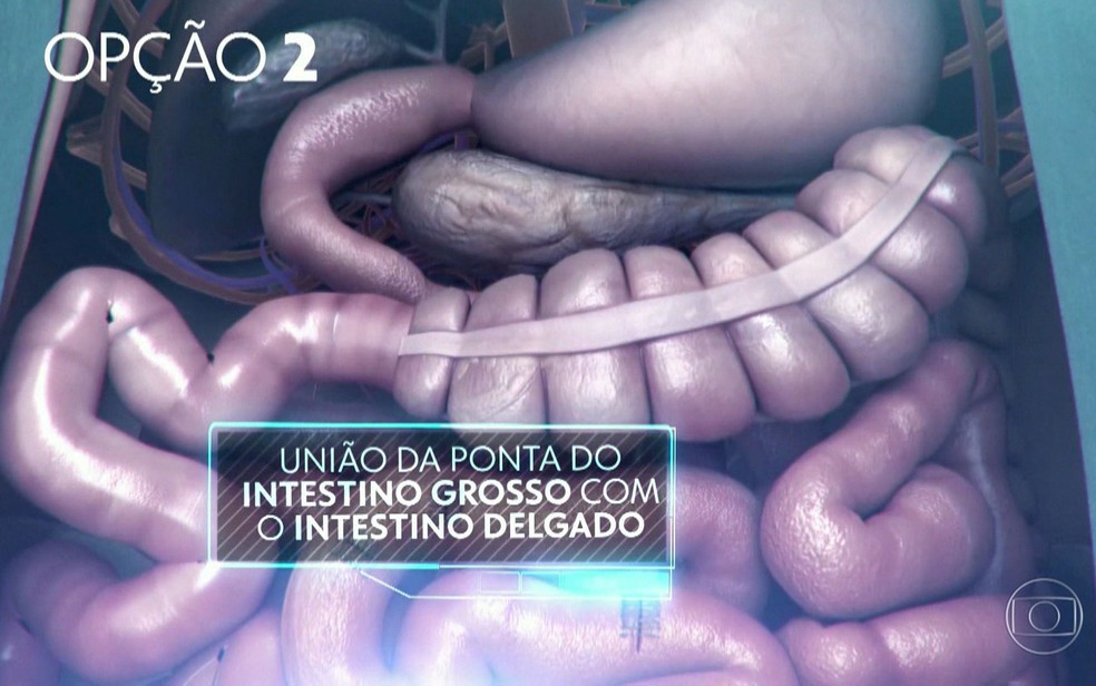 Opção usada pelos médicos foi unir a ponta do intestino grosso com o intestino delgado — Foto: TV Globo/Reprodução