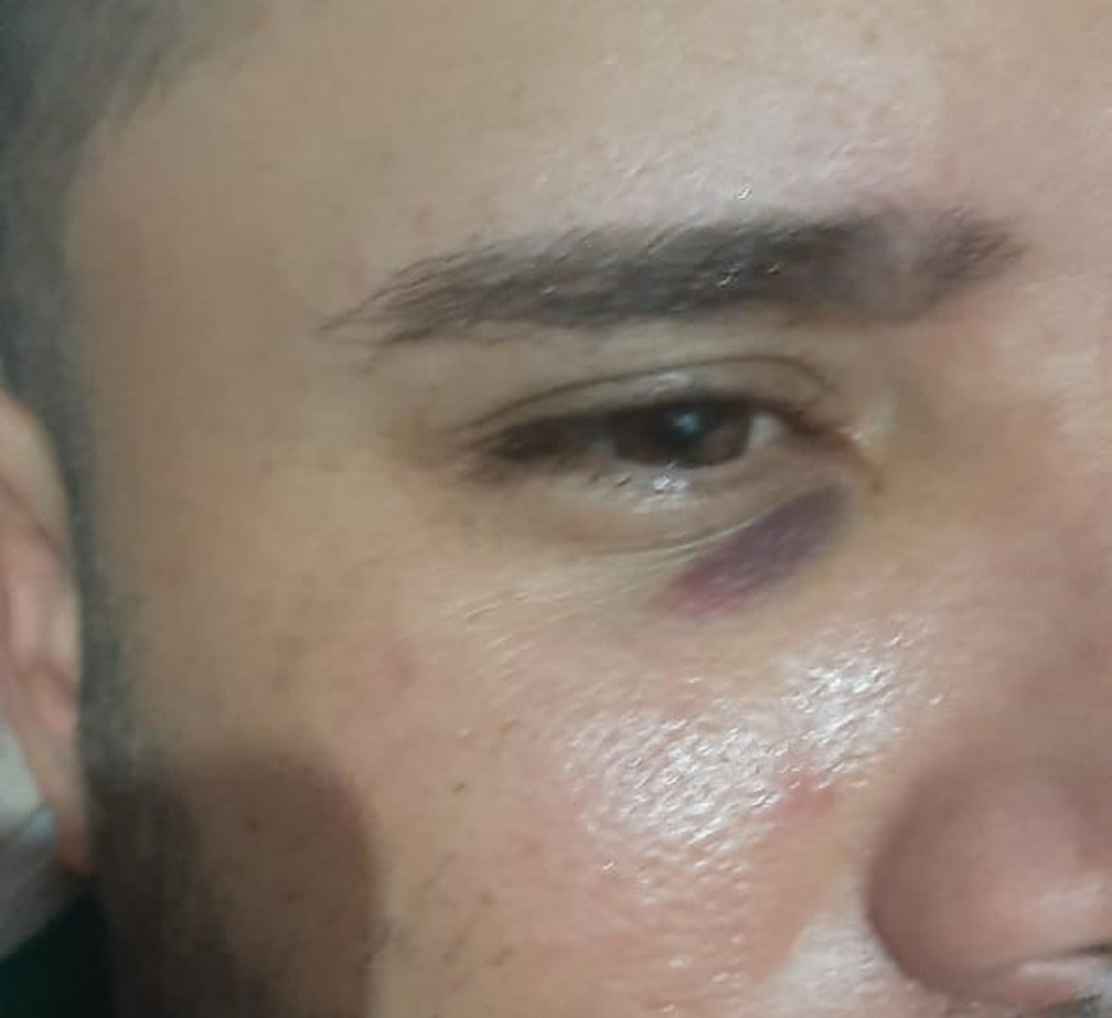 Marcas de agressão no rosto do empresário Jailton Pinto, que ele relata terem sido feitas pelo atacante Juninho — Foto: Arquivo Pessoal