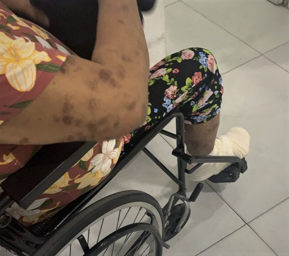 Paciente terá perna direita amputada da coxa para baixo em Guarujá, SP — Foto: Arquivo Pessoal