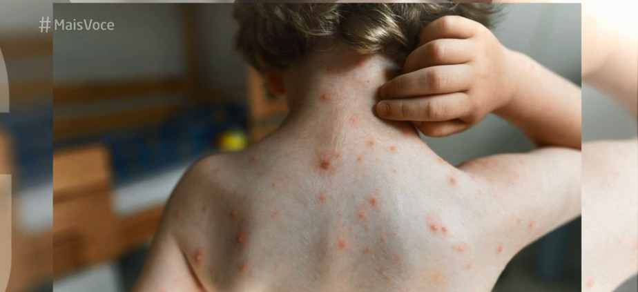 7 estados sofrem com surto de sarampo: médico tira dúvidas e alerta para vacinação