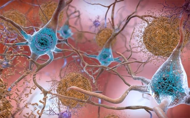 Ilustração mostra as placas amilóides intercaladas entre os neurônios (Foto: Divulagação/National Institute of Aging)