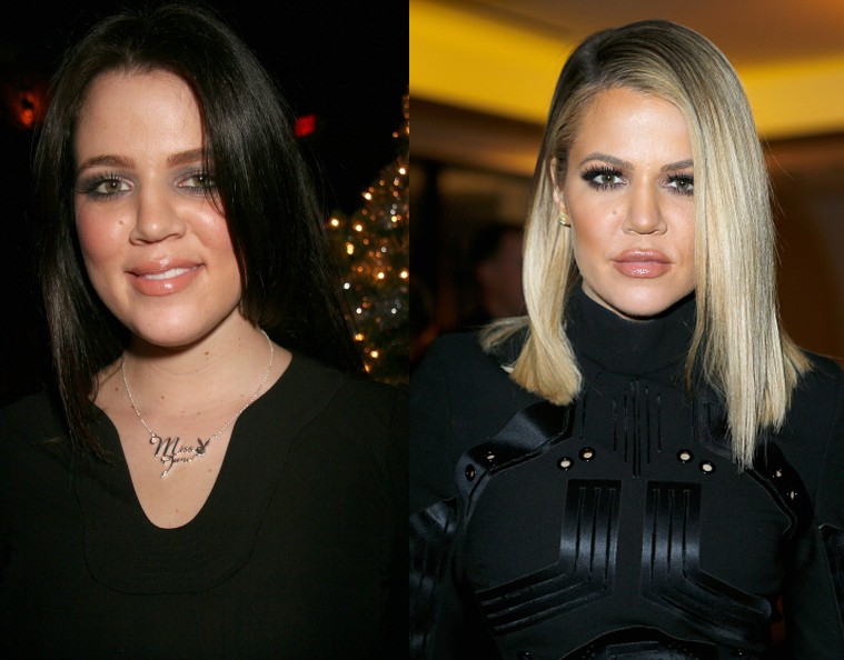 Khloé Kardashian: antes e depois (Foto: Getty Images)