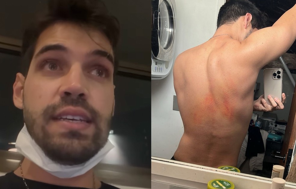 Influenciador Leo Lacerda publicou vídeo com relato e foto de hematoma nas costas  — Foto: Reprodução/Redes sociais