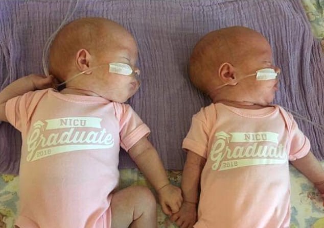 Gêmeas se preparam para primeiro Natal após cirurgia de risco quando ainda estavam no útero (Foto: Reprodução / Daily Mail)