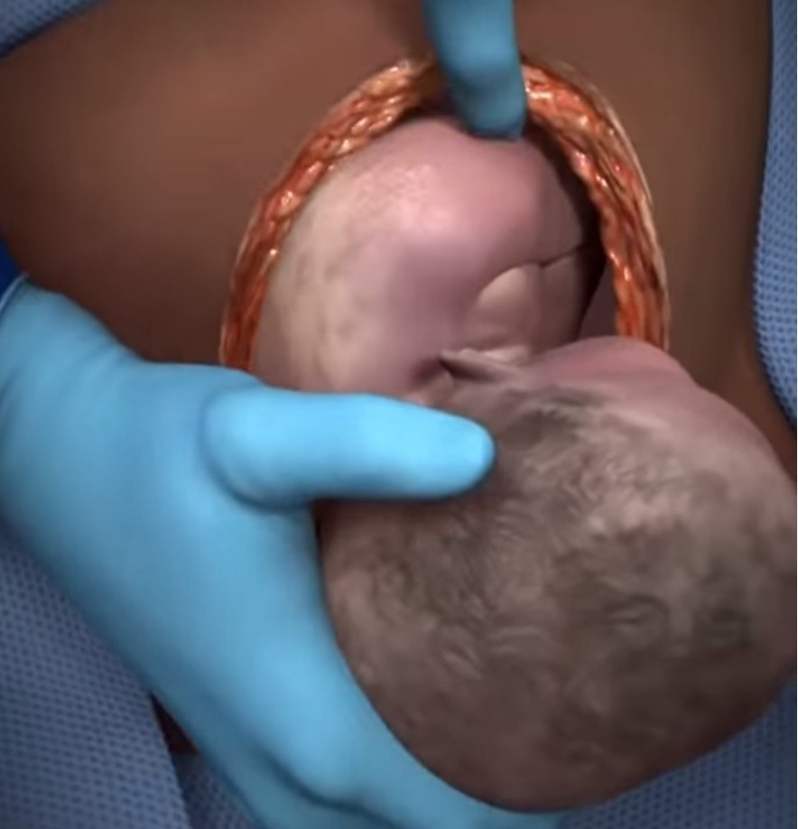 Vídeo mostra versão simplificada de cesárea (Foto: Touch Surgery)