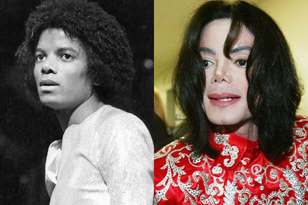 Michael Jackson talvez seja um dos exemplos mais emblemáticos entre os famosos com problemas com cirurgias plásticas. O cantor foi para a mesa de cirurgia pela primeira vez em 1979, quando quebrou o nariz durante um show. Ele acabou repetindo a dose várias vezes, tornando-se irreconhecível com o passar dos anos. Após sua morte, em 2009, a mãe de Jackson afirmou que o filho era viciado em cirurgias plásticas. (Foto: Getty Images)