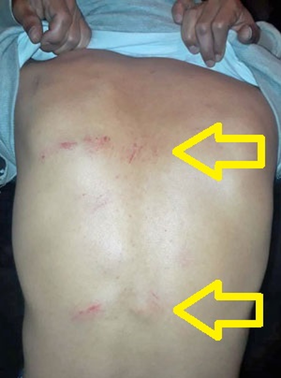 Flechas na foto indiciam ferimentos no ambulante Francinildo CÃ¢ndido causados por golpes de cassetete dados por policial militar (Foto: ReproduÃ§Ã£o/DivulgaÃ§Ã£o/Arquivo pessoal)