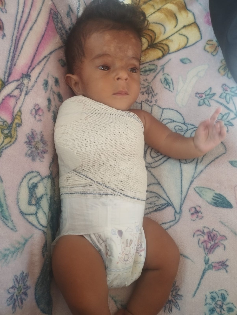 Fratura mais recente aconteceu há cerca de duas semanas, quando a mãe tirava a roupinha para dar banho no filho. — Foto: Cedida