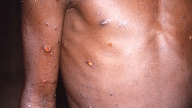 monkeypox (Foto: Getty Images)