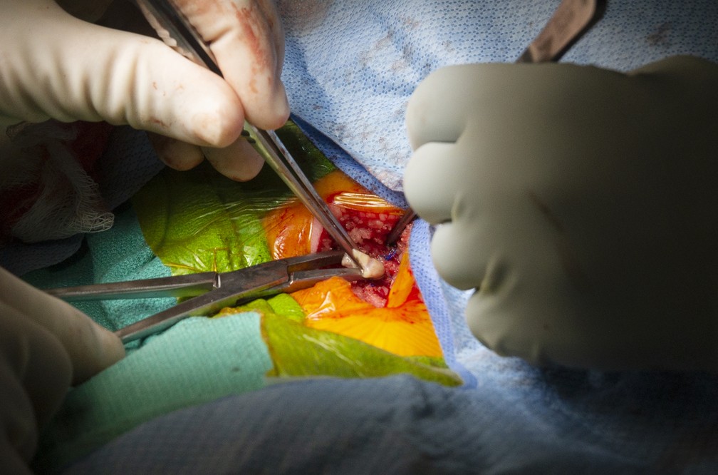 Foto mostra médicos fazendo transplante de timo em um bebê no Hospital Universitário de Duke, no estado americano da Carolina do Norte, em 16 de agosto de 2021. O bebê está se recuperando após passar por uma técnica para ajudar a evitar a rejeição do órgão. — Foto: Shawn Rocco/Duke Health via AP