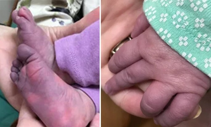 Mãos e pés de bebê de cinco meses ficaram azuladas  (Foto: Reprodução/The Sun)