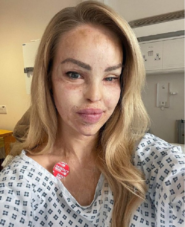 A ex-modelo e apresentadora Katie Piper em seu leito hospitalar após ser vítima de um engasgo (Foto: Instagram)