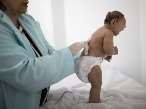 Um bebê com menos de 3 meses que nasceu com microcefalia é examinado por um neurologista do hospital Pedro I, em Campina Grande, na Paraíba (Foto: Felipe Dana/AP)