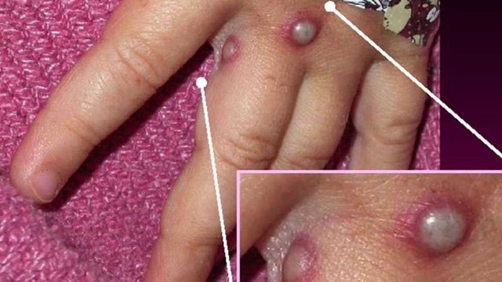 Essa é a mão de um dos 20 pacientes infectados com varíola dos macacos nos EUA em 2003, quando foram registrados os primeiros casos no continente americano — Foto: Getty Images via BBC