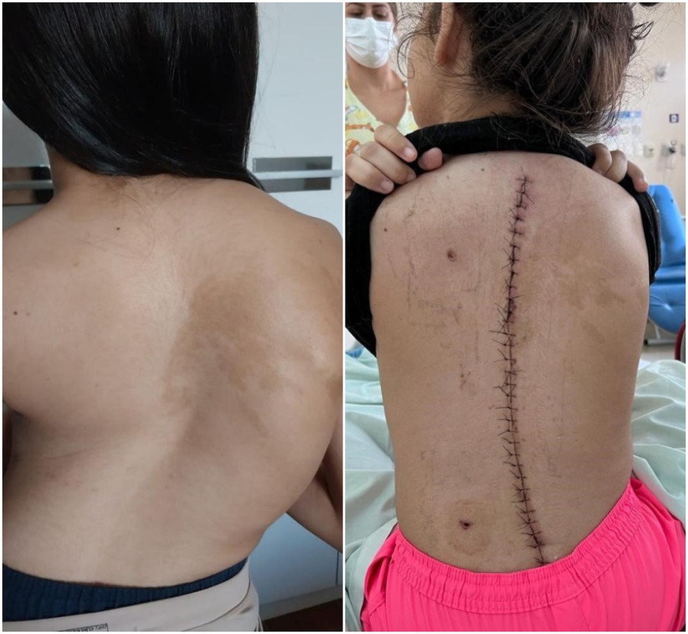 Menina de 12 anos antes e depois de cirurgia para escoliose grave em São Carlos — Foto: Santa Casa de São Carlos/Divulgação