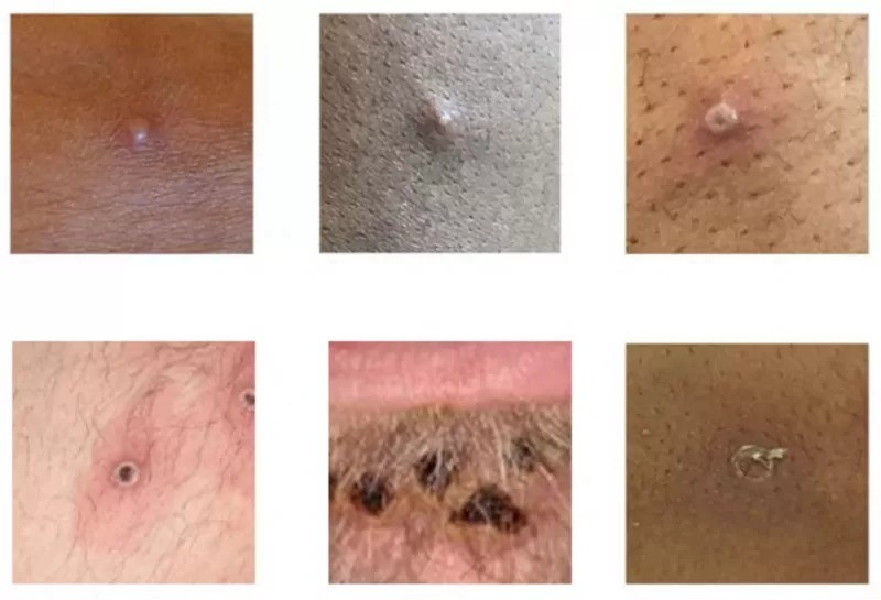 Alguns exemplos de lesões sugestivas de monkeypox (Foto: REUTERS via BBC)