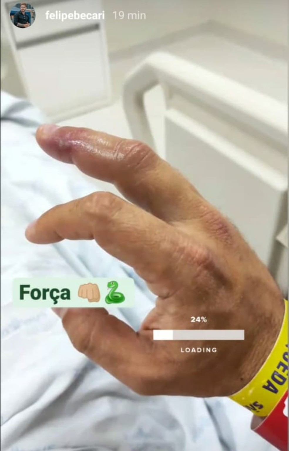 Felipe Becari mostra dedo picado por cobra jararaca — Foto: Divulgação/Instagram
