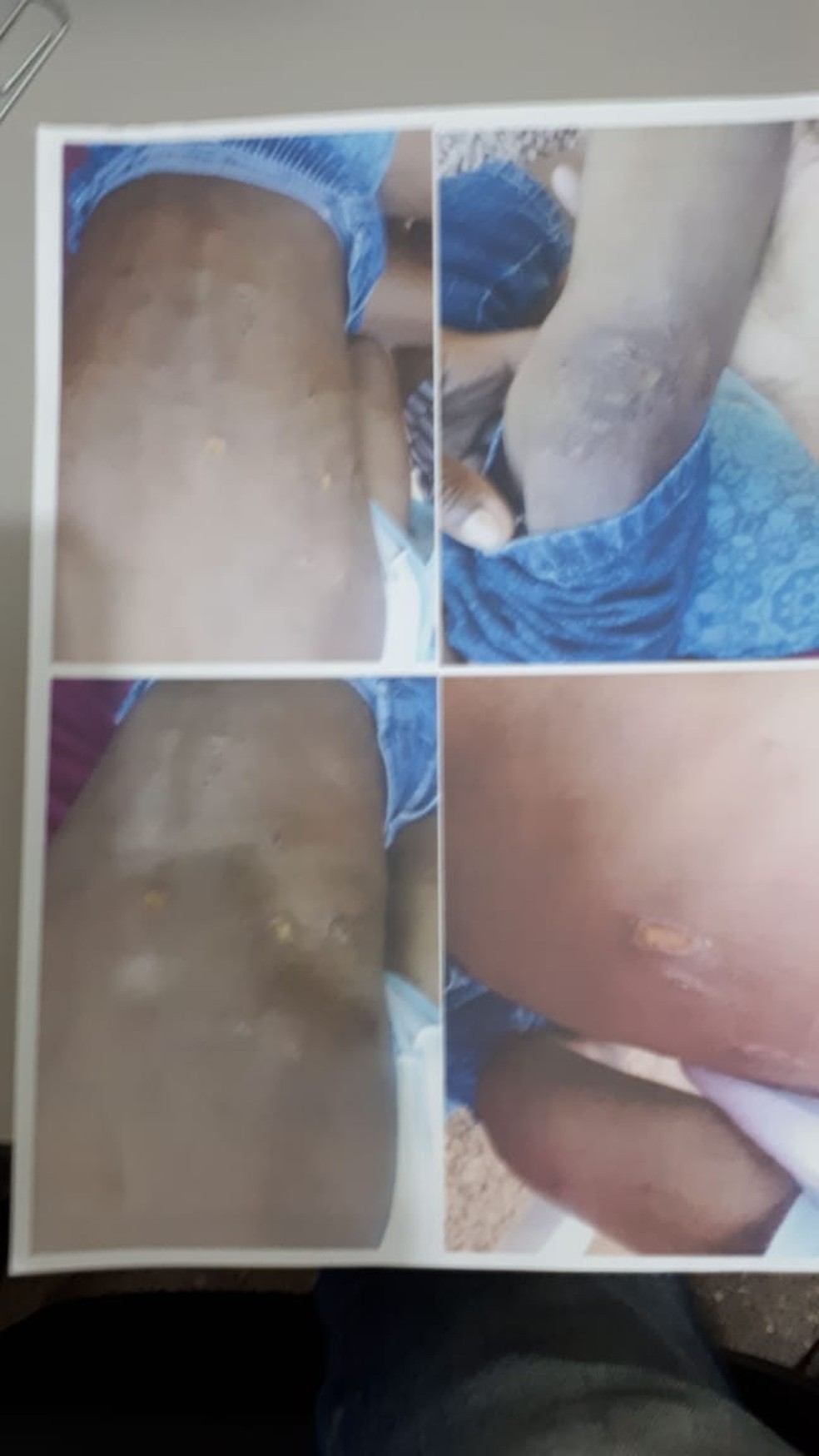 Fotos mostram machucados no corpo do menino de 5 anos torturado em Cuiabá — Foto: Leandro Trindade/TV Centro América