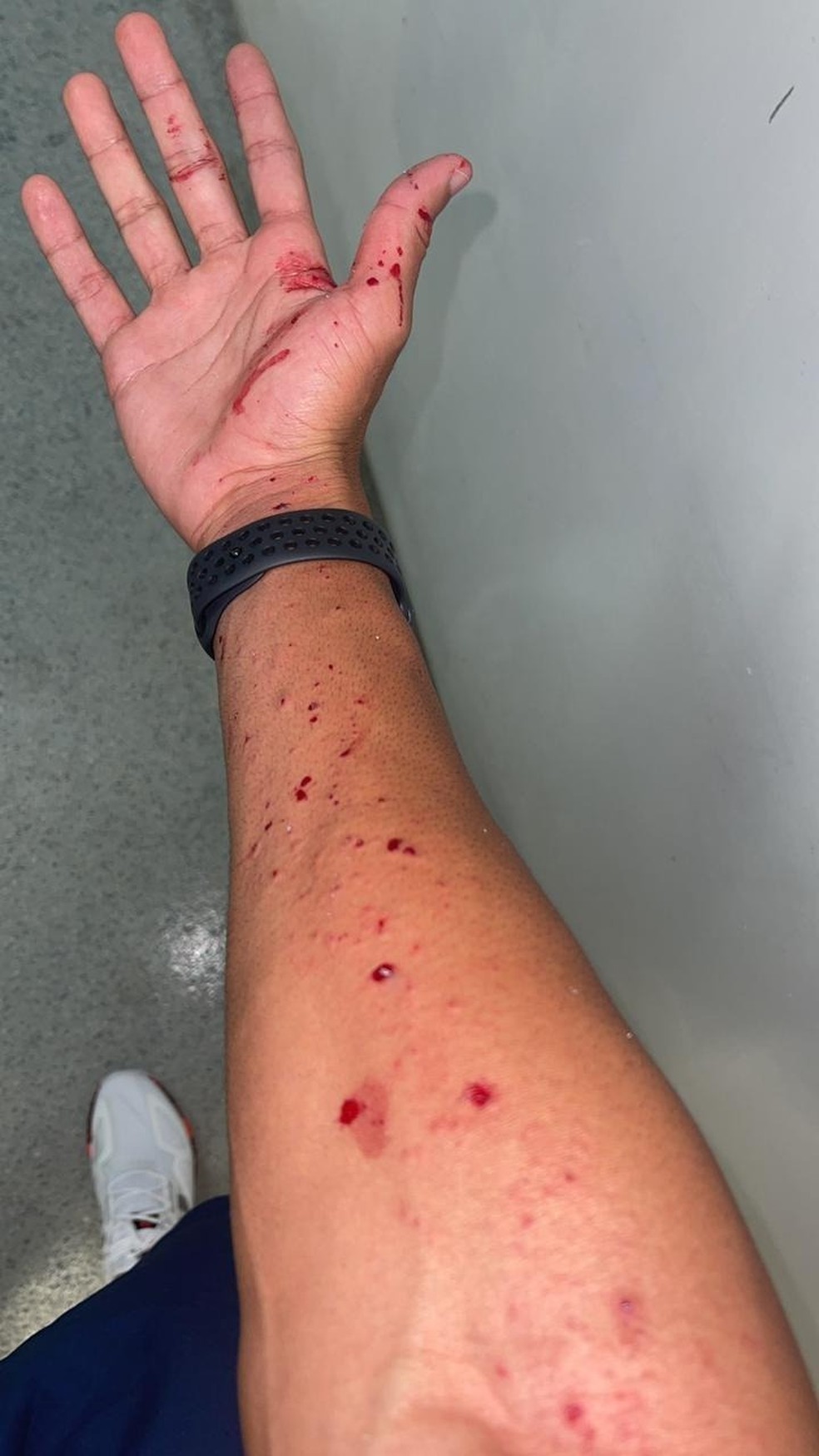 Matheus Bahia mostra cortes sofridos no braço em ataque a ônibus — Foto: Arquivo pessoal