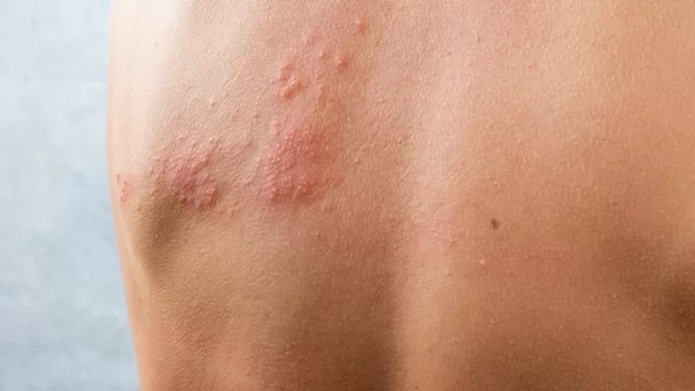 O herpes-zóster é marcado pela reativação do vírus causador da catapora — Foto: Getty Images via BBC