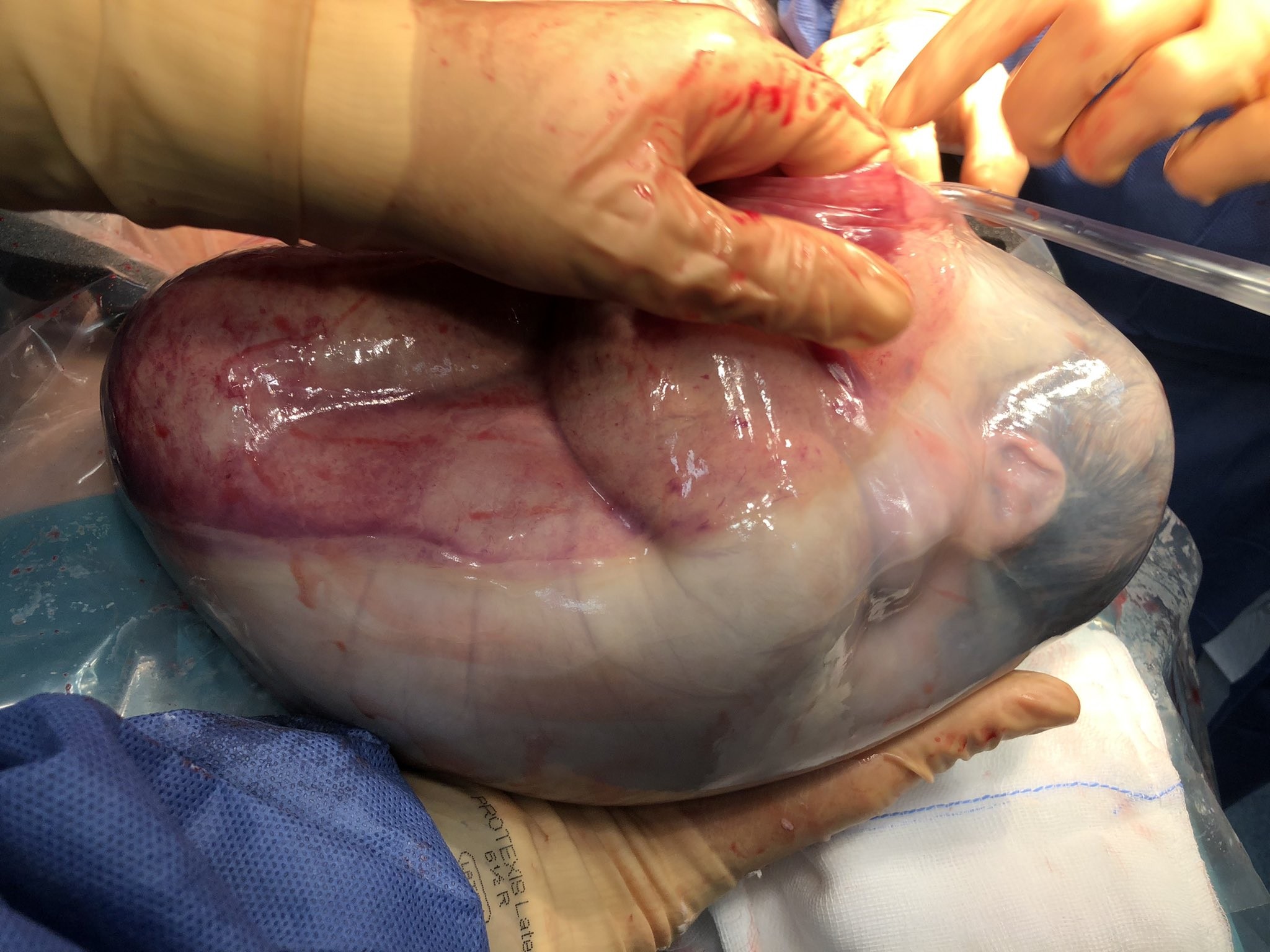 Médica se emociona em parto de gêmeos envolvidos por bolsa amniótica (Foto: reprodução/twitter)