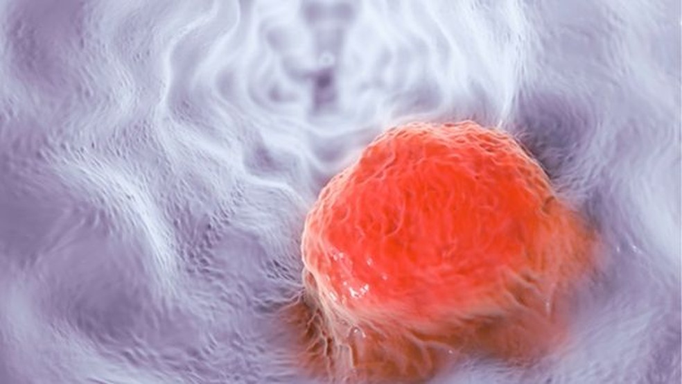 A ideia é descobrir se o câncer de esôfago (ilustração), por exemplo, deixa uma assinatura química na respiração — Foto: Science Photo Library