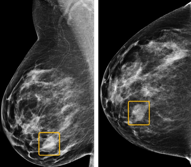 Inteligência artificial já é melhor que médicos para detectar câncer de mama (Foto: Reprodução Nature/Google Health)