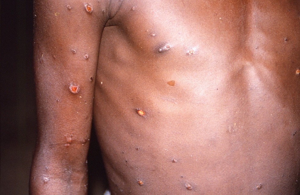 Corpo de um homem não identificado com marcas da varíola dos macacos — Foto: CDC/Brian W.J. Mahy/Handout via REUTERS 